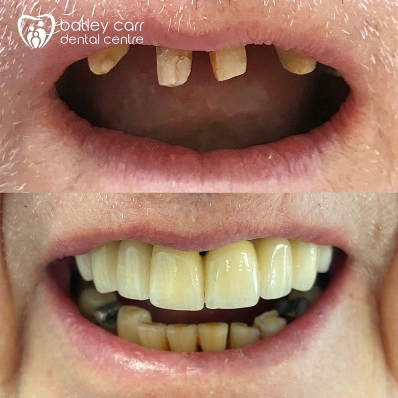 13.Full mouth reconstruction where patient had lost a bridge. New bridge was made and a denture constricted Aesthetics and function restored p 800 1